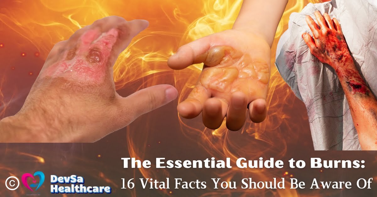 A graphic featuring three images of burn injuries: a severely burned hand with blisters, a partially burned palm, and a heavily injured leg wrapped in cloth. The background shows bright flames, symbolizing heat or fire. The text on the image reads, "The Essential Guide to Burns: 16 Vital Facts You Should Be Aware Of," with the DevSa Healthcare logo in the corner.