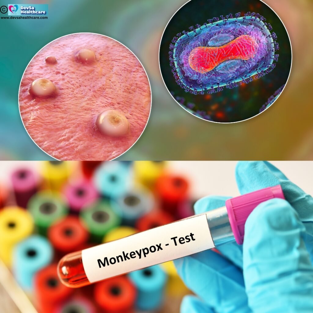 Diagnosis of Monkeypox by Devsa healthcare