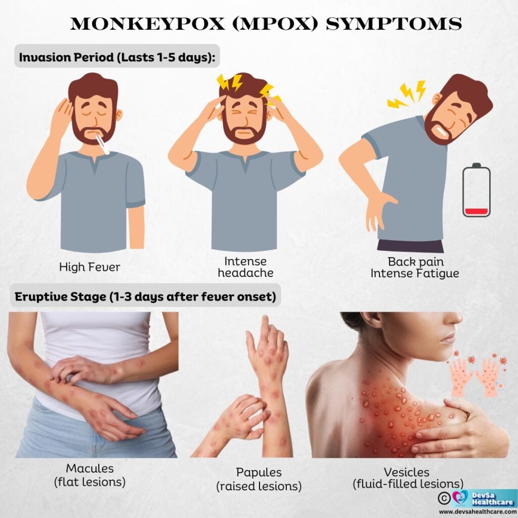 Monkeypox (Mpox) Symptoms by DevSa Healthcare