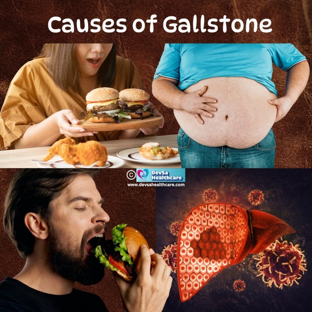 Causes of Gallstone by DevSa Healthcare