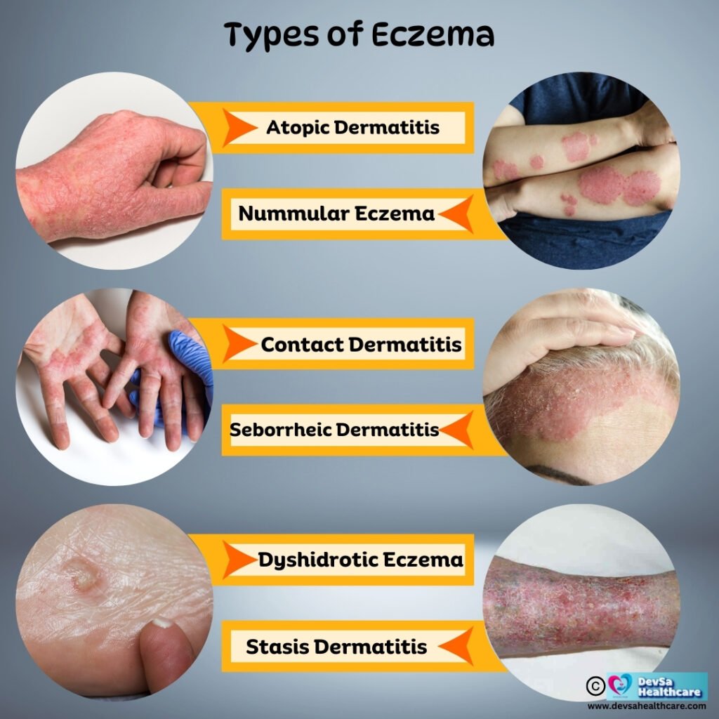 Types of Eczema by DevSa Healthcare