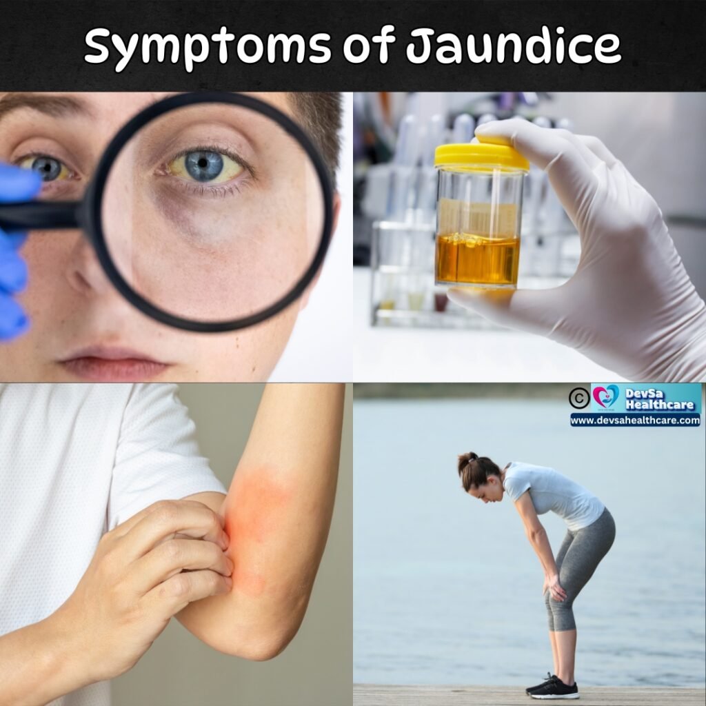 Symptoms of Jaundice by DevSa Healthcare